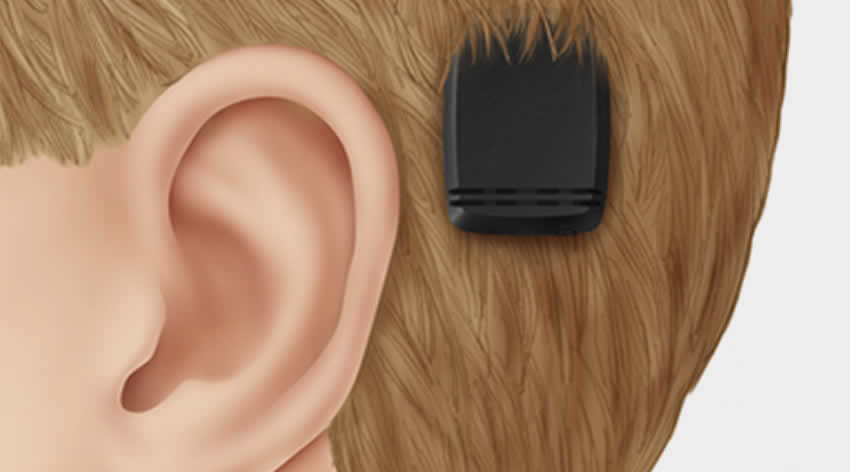 tn-bone-anchored-hearing-aid
